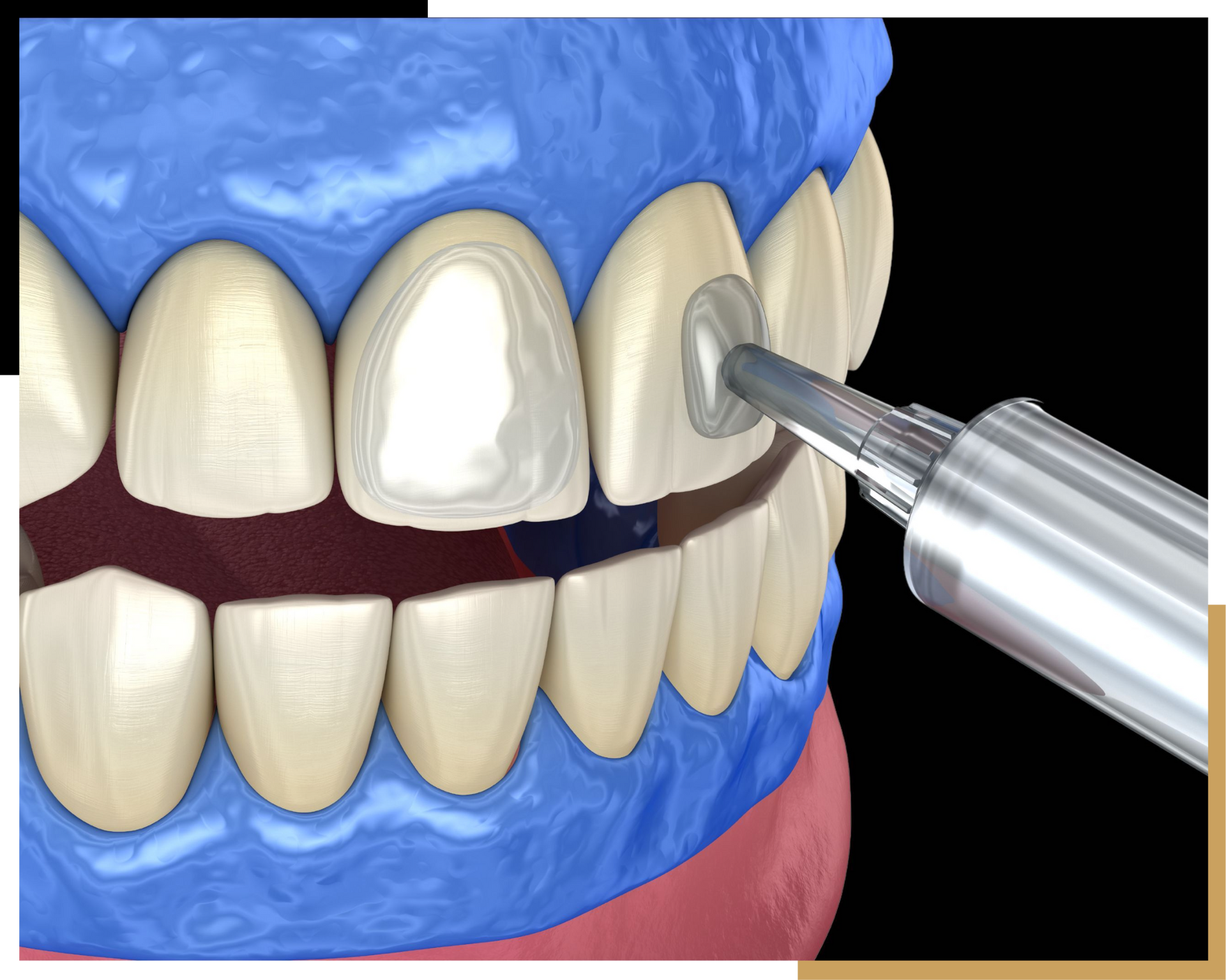 Custom Smile Design Services in Jacksonville | Cre8 Smile Studio